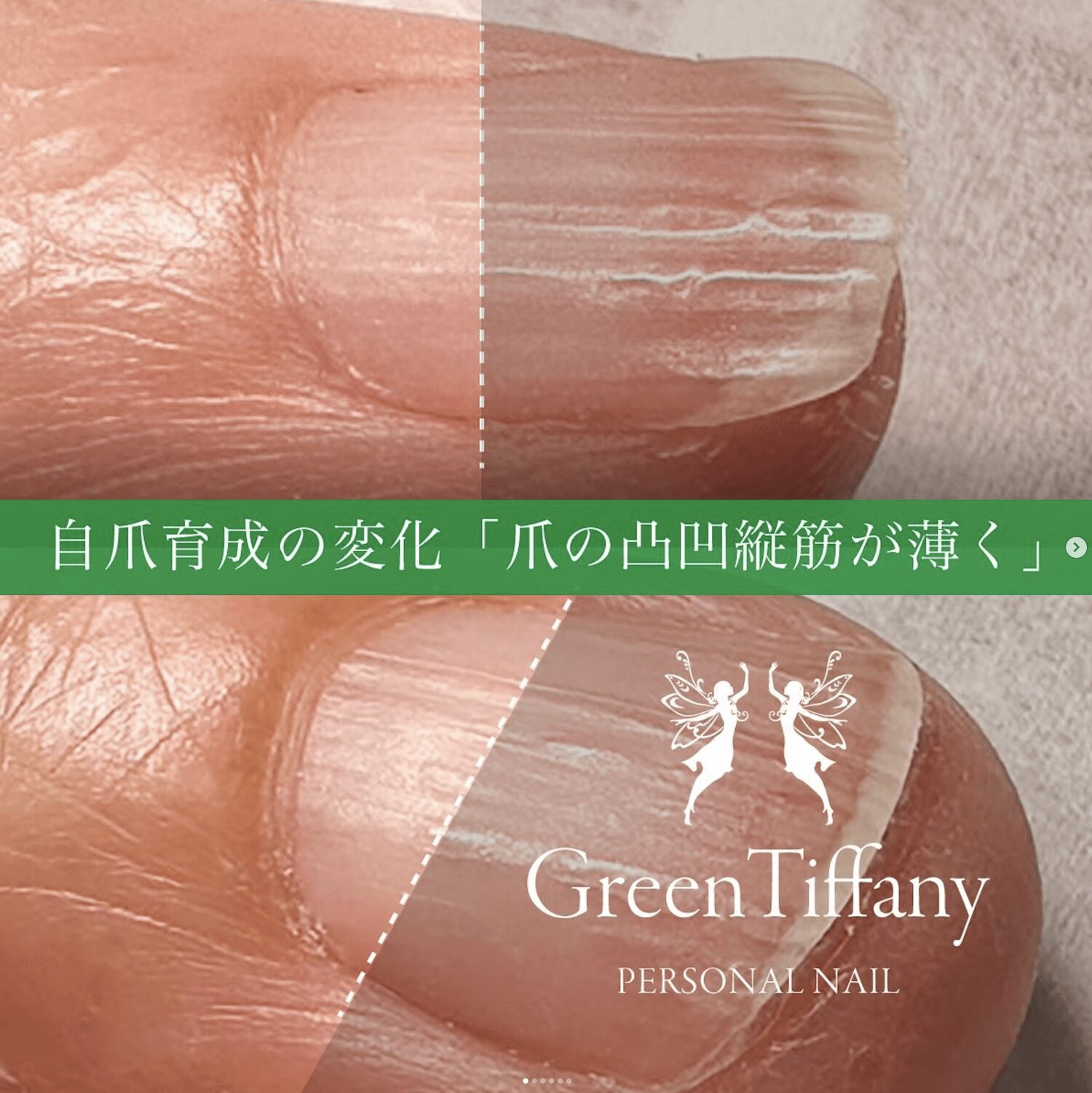 【期間限定価格】爪 基礎から臨床まで 爪 基礎から臨床まで 改訂第2版 | 東 禹彦 |本 | 通販 | Amazon